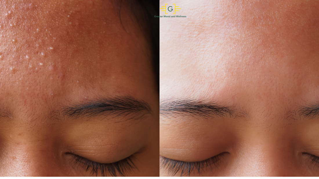 Before and after images of a woman with forehead acne, illustrating the impact of treatment and key ingredients for care.