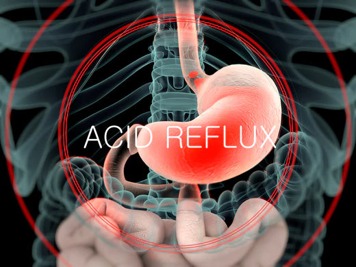 Acid Reflux - What is it and how can it be treated?