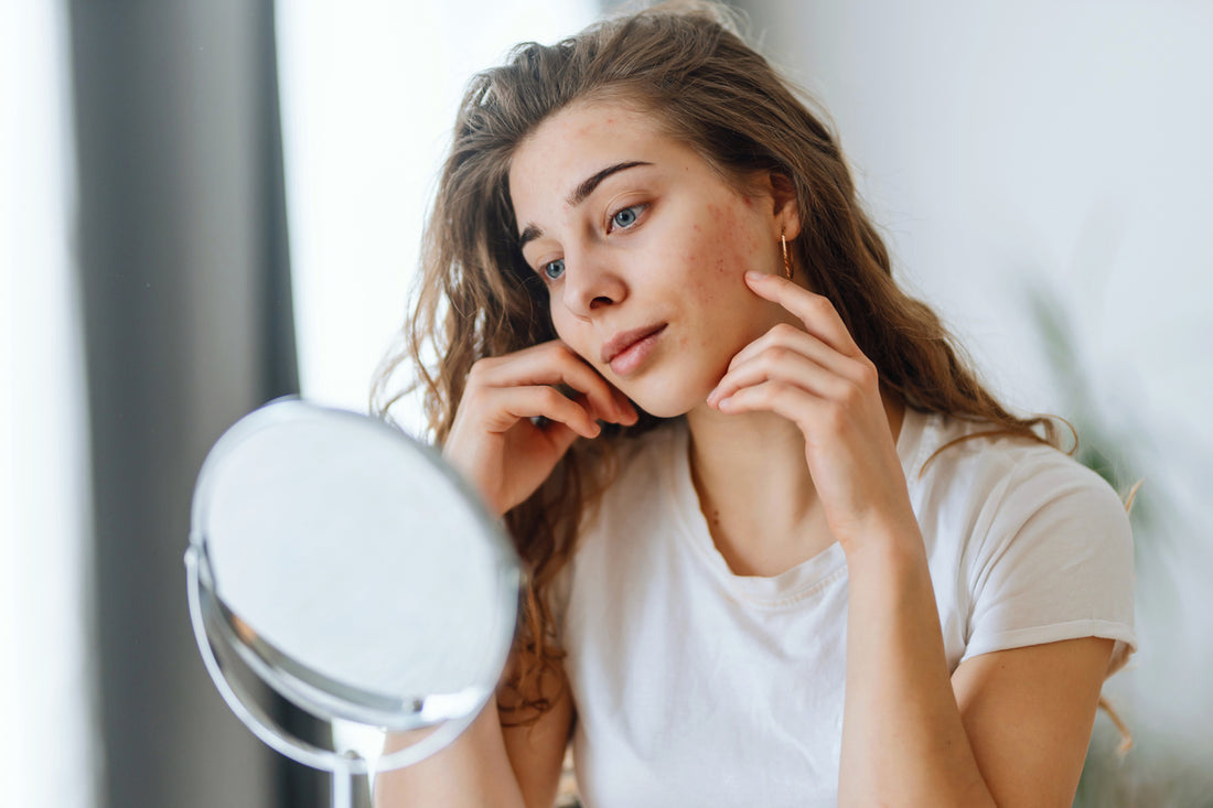 Picture of a woman looking in a mirror with chapped skin due to cold weather